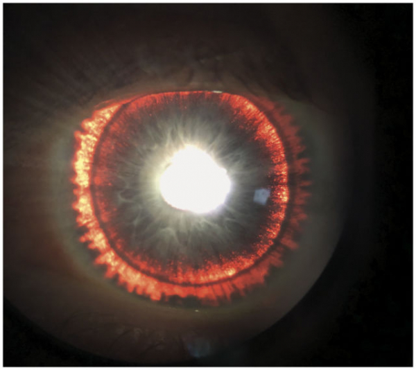Редкое генетическое заболевание превратило глаз мужчины в «око Саурона»