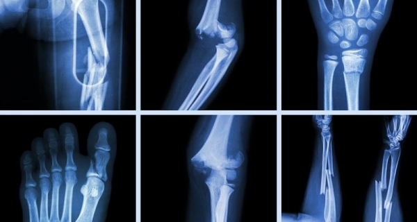 Датский стартап начал печать индивидуальных протезов костей